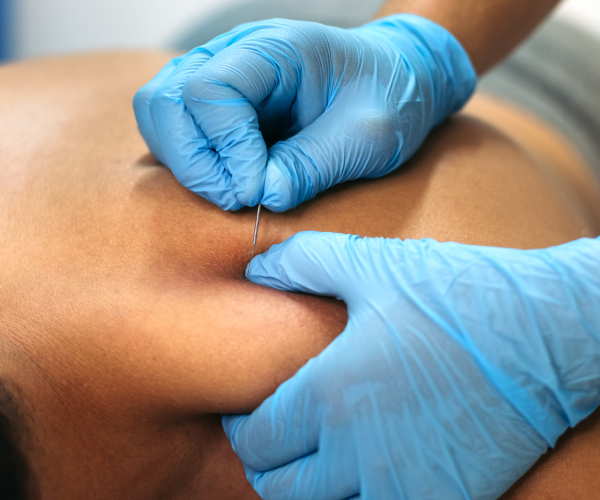 Fysiopunt Laarbeek Dry Needling